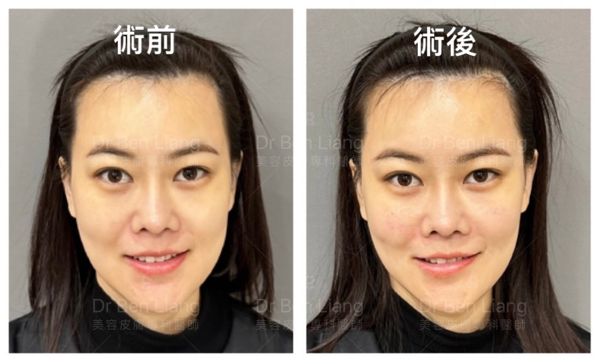 正面術前術後結構微調比較